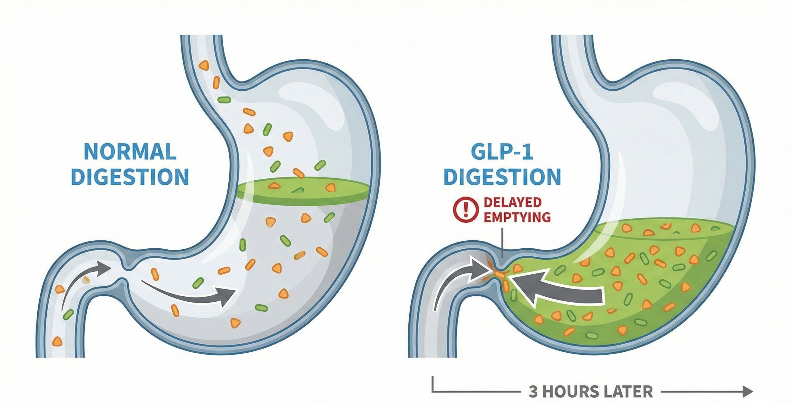 Medical illustration comparing normal digestion vs GLP-1 delayed gastric emptying showing the traffic jam effect